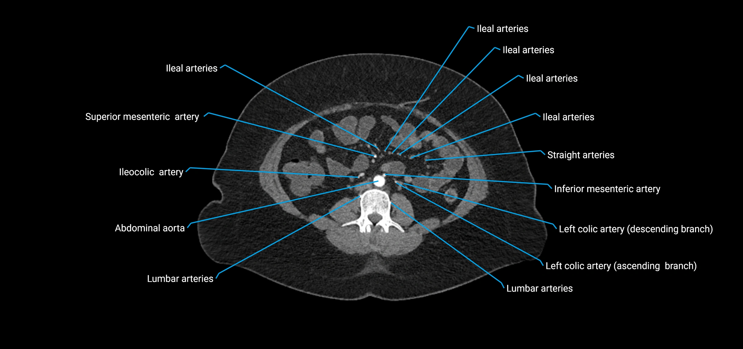 CTA abdomen axial cross sectional anatomy labelled image_114 (2).webp